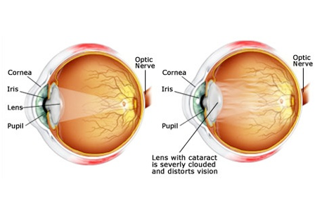 Cataracts image