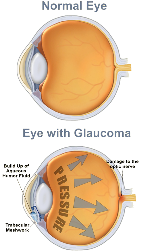 glaucoma_image
